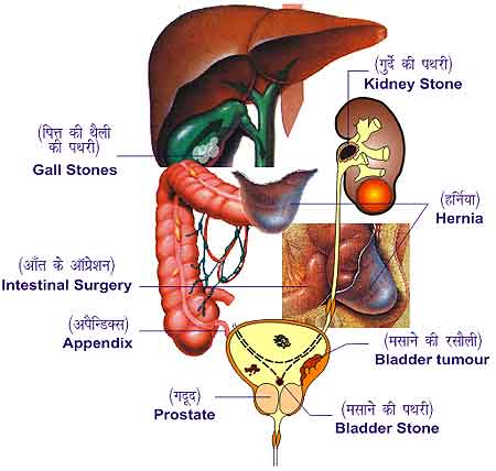 Laproscopy Surgeon in Meerut