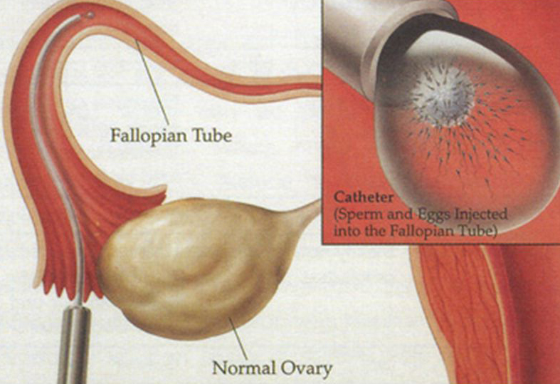 ivf centre in Meerut